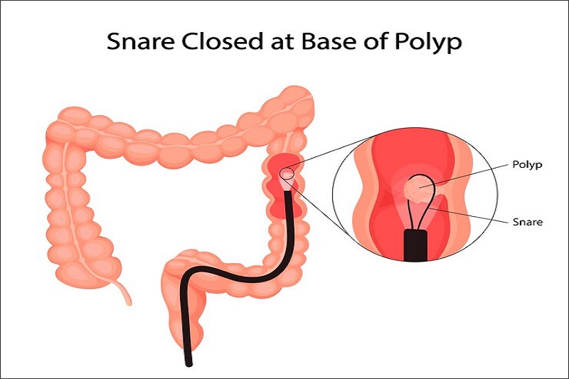 Sử dụng vòng cắt điện loại bỏ polyp đại tràng