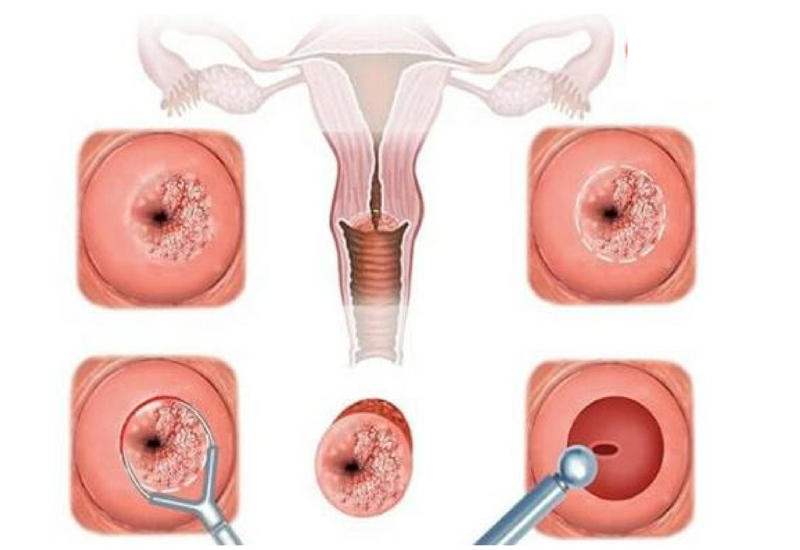 Viêm cổ tử cung mạn tính có gây ra triệu chứng gì và cách điều trị như thế nào?