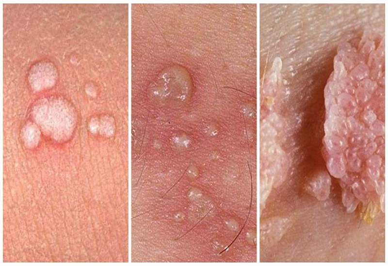 Các nốt sùi do bệnh sùi mào gà thường phát triển nhanh, kết lại thành từng cụm lớn trông như mào gà hoặc hoa súp lơ