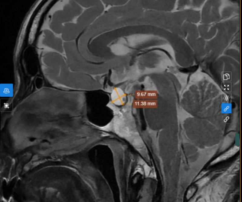 Hình ảnh khối u được phát hiện trên kết quả chụp MRI tuyến yên 