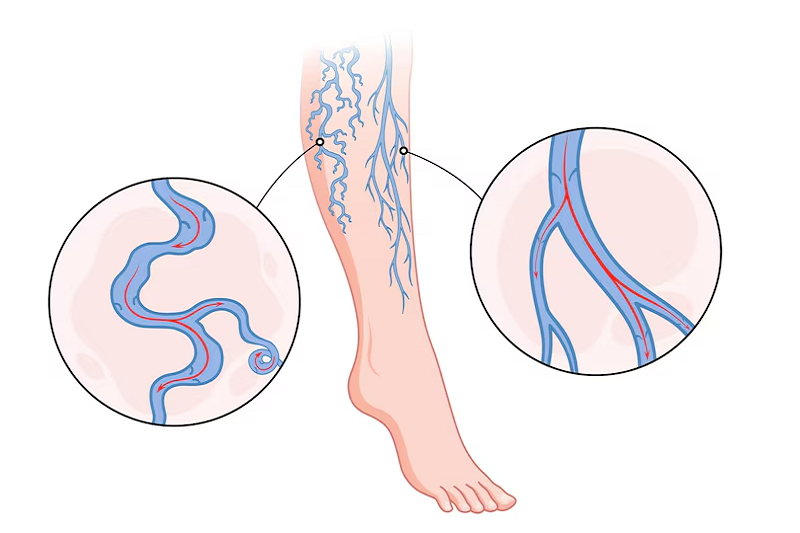 Tiền sử giãn tĩnh mạch chân có thể làm tăng nguy cơ nhức mỏi chân về đêm khi mang thai 
