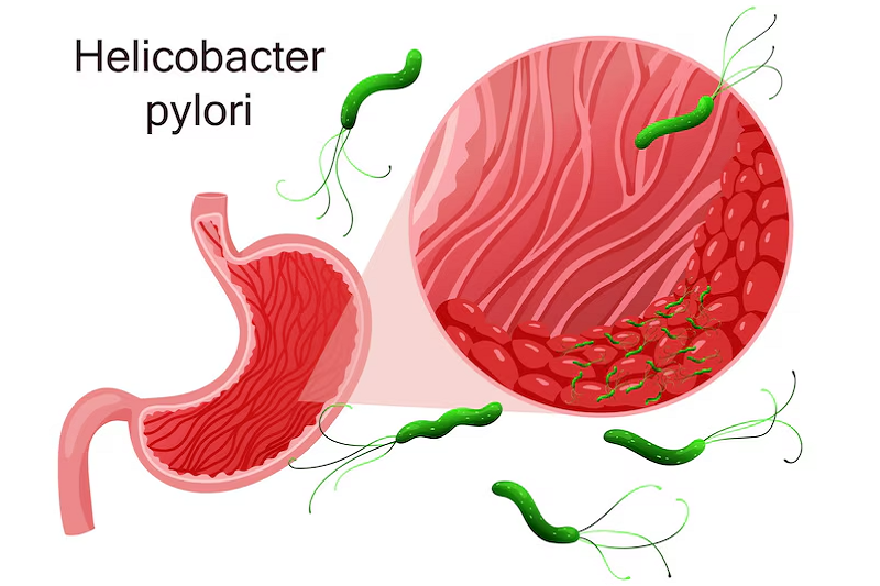 Helicobacter pylori có thể gây bệnh viêm teo niêm mạc dạ dày C2