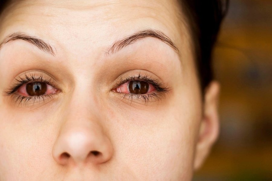 Không nên tự ý điều trị đau mắt đỏ theo các phương pháp truyền miệng