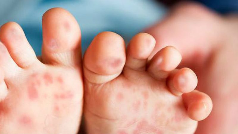 Chân tay miệng là bệnh truyền nhiễm cấp tính, do virus đường ruột gây ra
