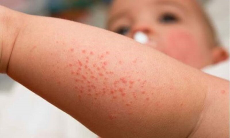Sởi là bệnh truyền nhiễm cấp tính nguy hiểm, gây ra bởi virus sởi và lây qua đường hô hấp