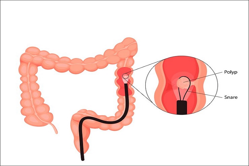 Hình ảnh mô phỏng thao tác lấy mẫu sinh thiết polyp đại tràng