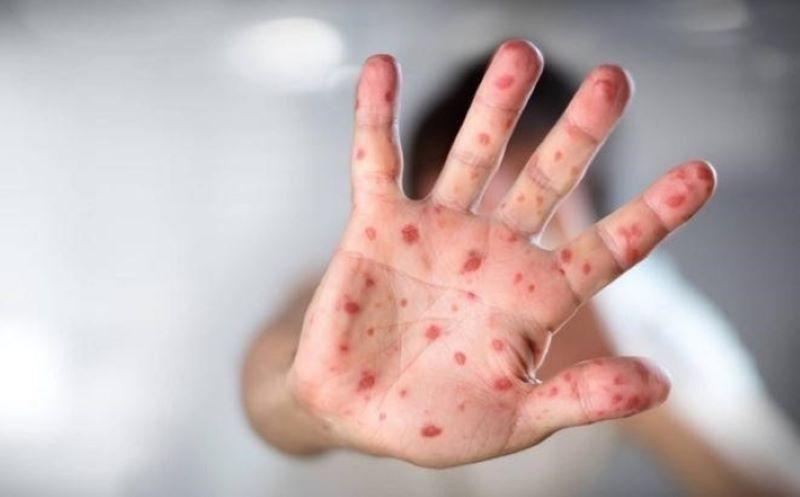 Chân tay miệng là bệnh nhiễm trùng cấp tính do virus đường ruột gây ra