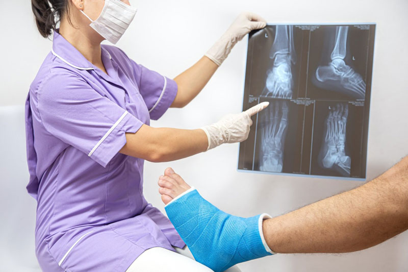 Nếu xương bị gãy nghiêm trọng, bệnh nhân thường phải bó bột