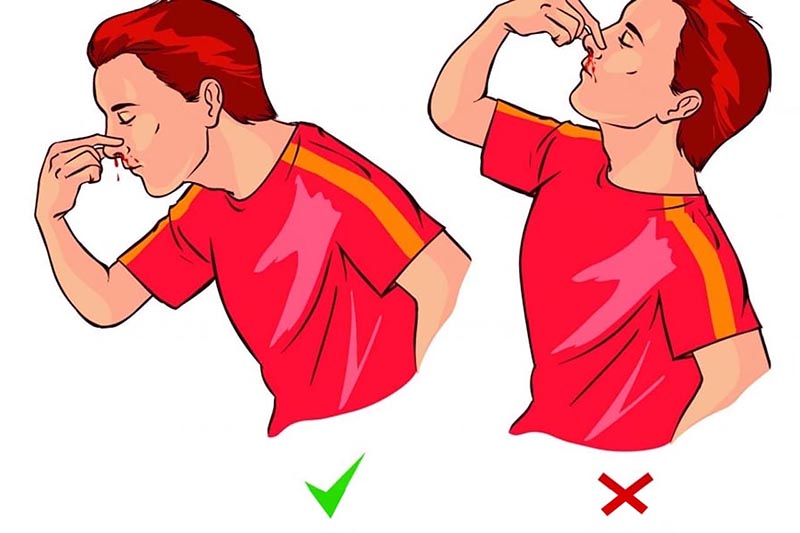 Hướng dẫn sơ cứu chảy máu chảy máu cam đúng cách