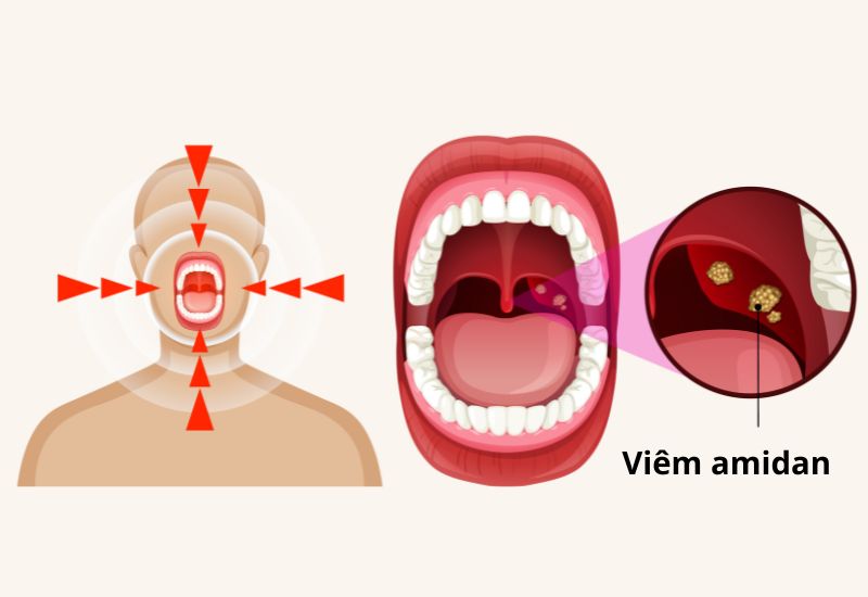 Amidan lại trở thành ổ viêm mạn tính, gây khó khăn cho người bệnh cả khi thở, nuốt và khi ngủ