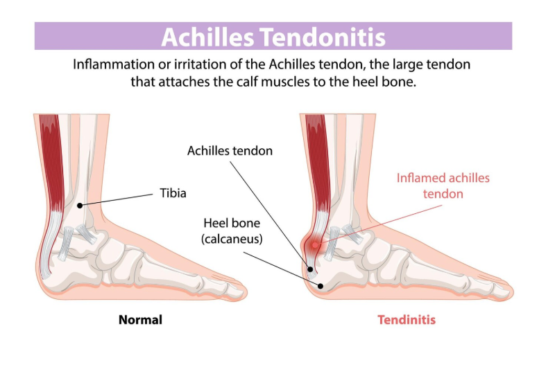 Hình ảnh mô tả tình trạng tổn thương do viêm gân gót chân Achilles