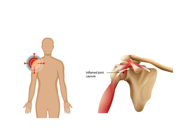 Hình ảnh mô phỏng tình trạng sưng, đau do viêm gân cơ trên gai vai phải