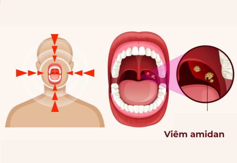 Viêm amidan hốc mủ là tình trạng viêm nhiễm kéo dài ở amidan, trong đó các hốc amidan tích tụ mủ trắng hoặc vàng