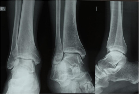 Chụp X quang xương cổ chân tại bệnh viện đa khoa MEDLATEC