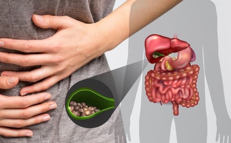 Chuyên gia cảnh báo người dân tuyệt đối không được chủ quan trước tình trạng sỏi túi mật  