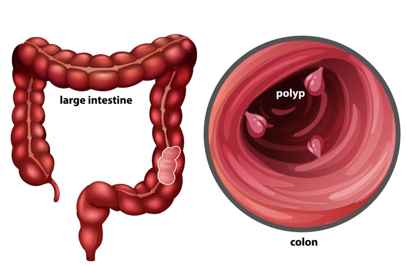 Ung thư đại trực tràng khởi phát từ các polyp tuyến lành tính