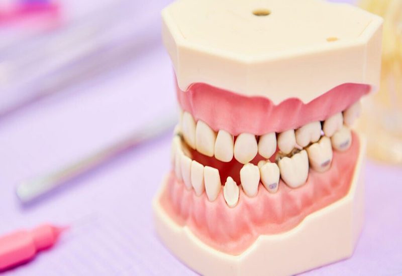 Quá trình niềng răng khớp cắn ngược là gì?