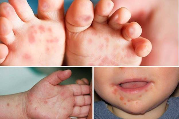 Cha mẹ cần hết sức lưu ý tránh nhầm chân tay miệng với bệnh khác