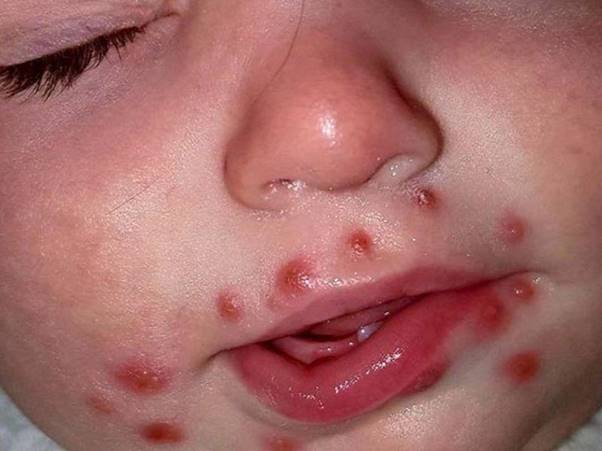 Bệnh tay chân miệng gây ảnh hưởng đến giấc ngủ của trẻ