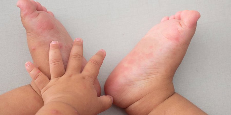 Nhấn vào ảnh để phóng to Bệnh tay chân miệng do nhóm virus đường ruột gây ra