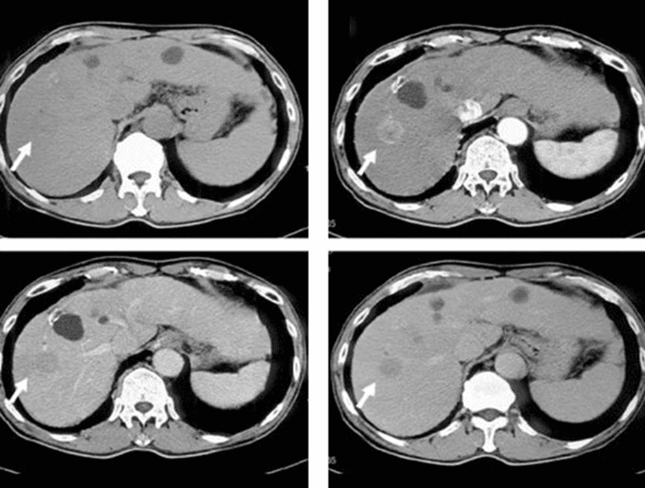  CT ổ bụng là công cụ ưu tiên trong đánh giá đau bụng cấp