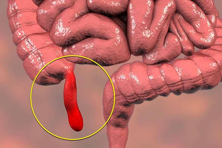 Viêm ruột thừa có thể gây đau bụng dưới