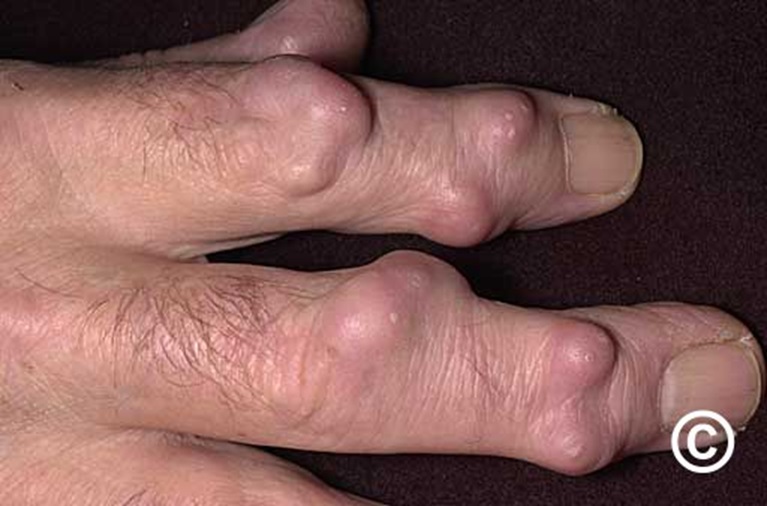 Hạt thấp khớp trong viêm khớp dạng thấp