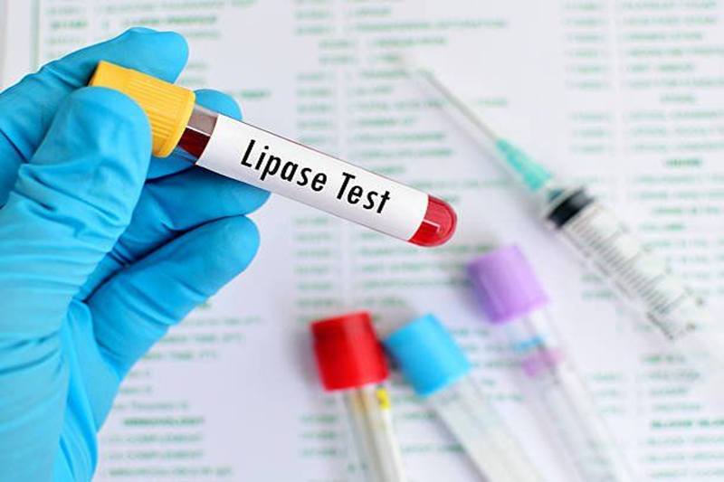 Lipase là xét nghiệm rất có ý nghĩa trong chẩn đoán viêm tụy cấp