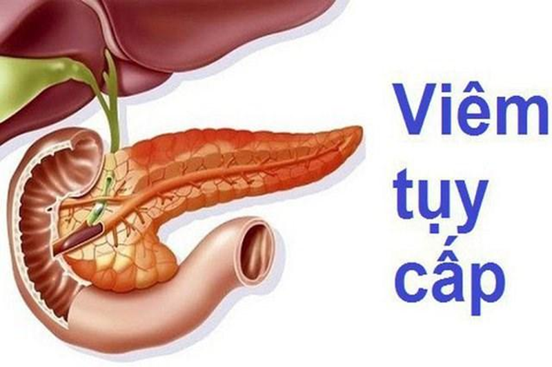 Viêm tụy cấp là bệnh lý rất nguy hiểm