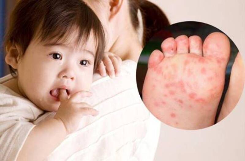 Chân tay miệng là bệnh truyền nhiễm cấp tính, thường gặp ở trẻ dưới 5 tuổi 