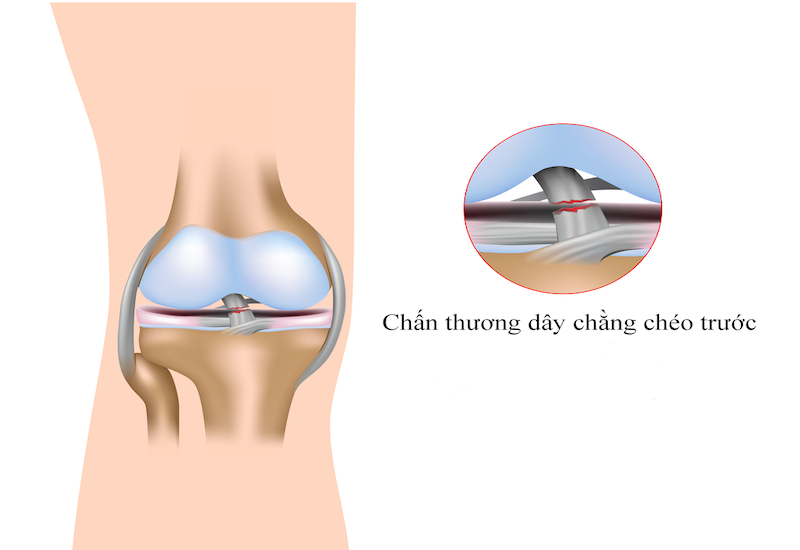 Dây chằng chéo trước nằm bên trong khớp gối