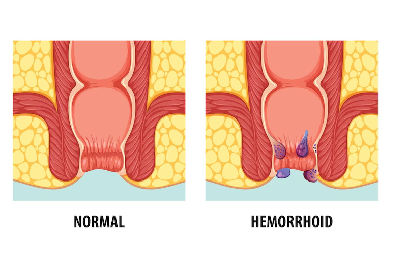 Hình ảnh giúp hình dung về vị trí của búi trĩ ngoại