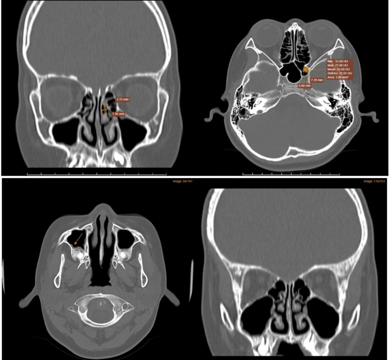 Hình ảnh chụp CT-Scanner xoang phát hiện tình trạng viêm đa xoang hàm mặt  