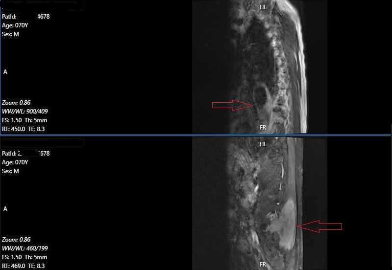 Hình ảnh khối lớn mô mềm ở cạnh cột sống phải của bệnh nhân qua hình ảnh MRI 