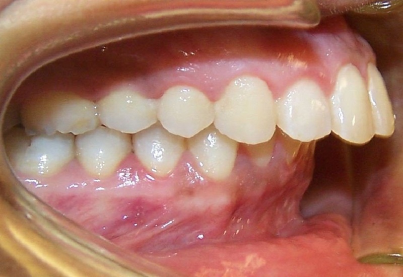 Khớp cắn sâu là tình trạng răng hàm trên che phủ quá mức răng hàm dưới khi ngậm miệng ở tư thế nghỉ