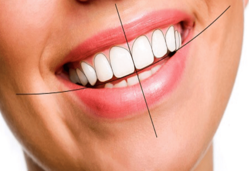 Nâng khớp cắn giúp điều chỉnh chiều cao khớp cắn giữa hàm trên và dưới