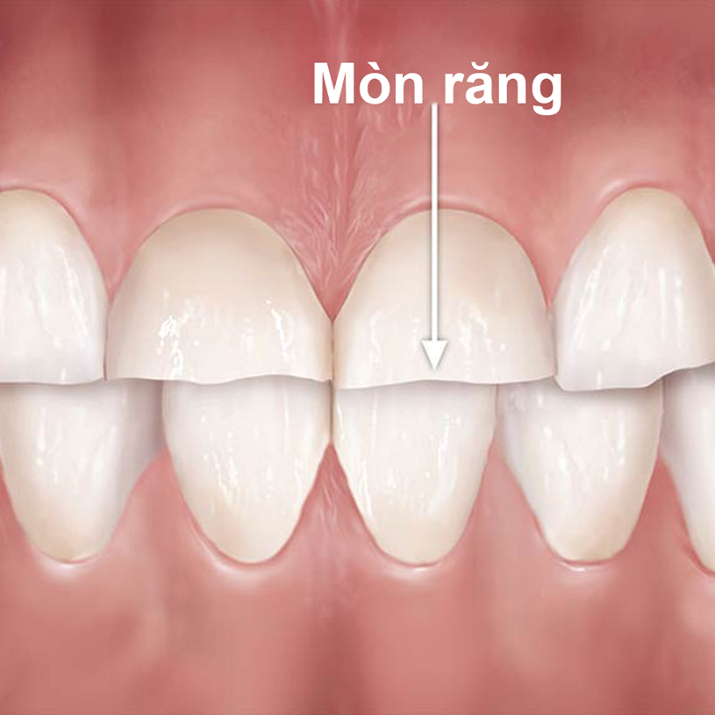 Người bị mòn răng nghiêm trọng cần điều chỉnh khớp cắn