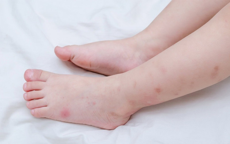 Muỗi đốt có khả năng để lại vết thâm trên da của trẻ 