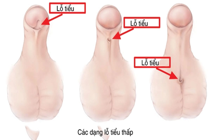 Dị tật lỗ tiểu lệch thấp khá phổ biến ở trẻ nam