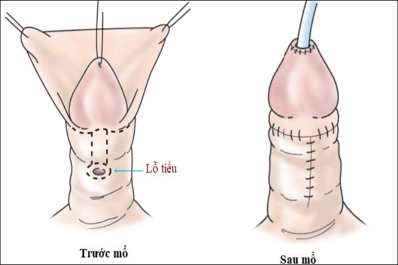 Phẫu thuật là liệu pháp điều trị triệt để lỗ tiểu lệch thấp