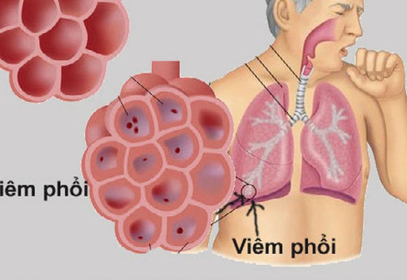 Những triệu chứng chính của viêm phổi cấp là gì?
