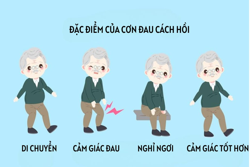 ABI bất thường có thể gây các cơn đau cách hồi