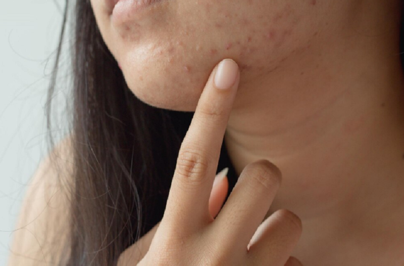 Mụn nội tiết ở cằm thường có nguy cơ sưng viêm và dễ gây sẹo thâm