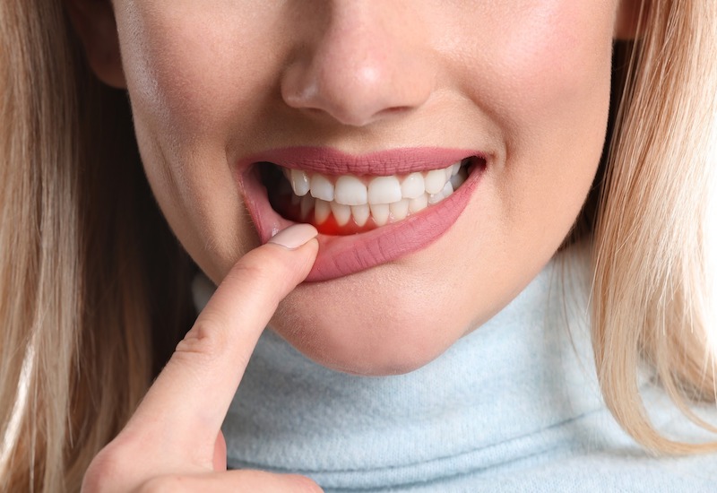 Viêm nha chu nặng có thể gây ra những tổn thương như thế nào cho răng và mô mềm xung quanh?