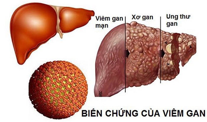 Ung thư gan là một biến chứng cực kỳ nguy hiểm