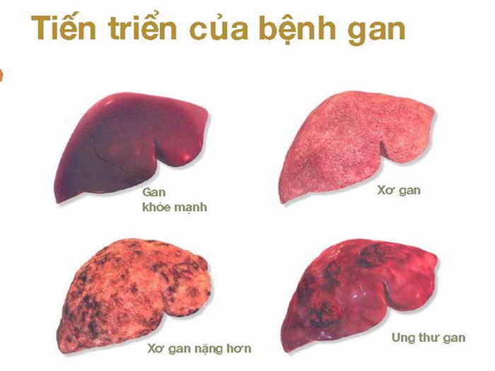 Bệnh viêm gan B mãn tính rất nguy hiểm và chưa có biện pháp điều trị dứt điểm