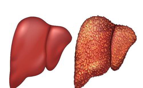 Viêm gan B là một bệnh truyền nhiễm do virus viêm gan B (HBV) gây ảnh hưởng đến gan