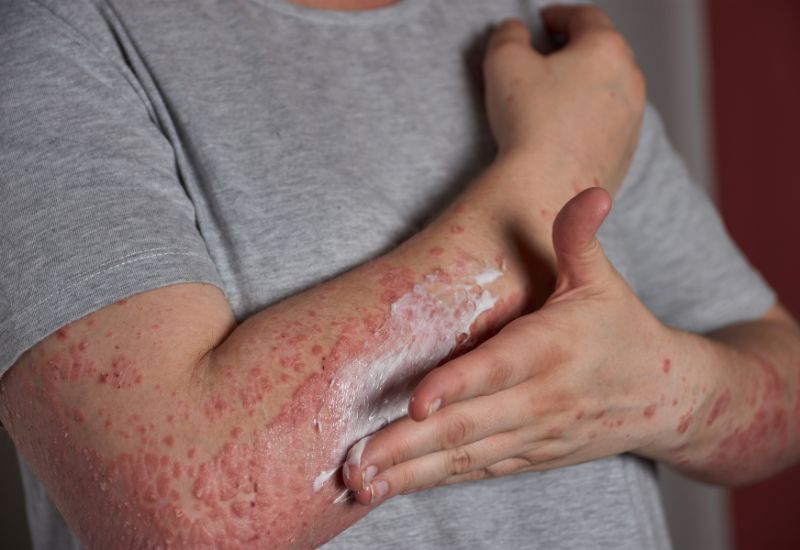 Biểu hiện thường thấy của viêm mao mạch dị ứng gồm phát ban dạng chấm tím