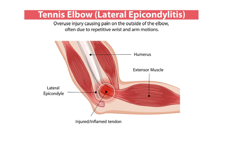 Hình ảnh mô tả tổn thương trong hội chứng Tennis Elbow