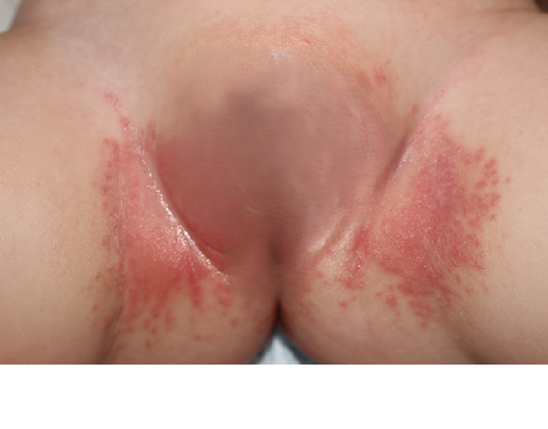 Tổn thương viêm da tã lót do nấm Candida.